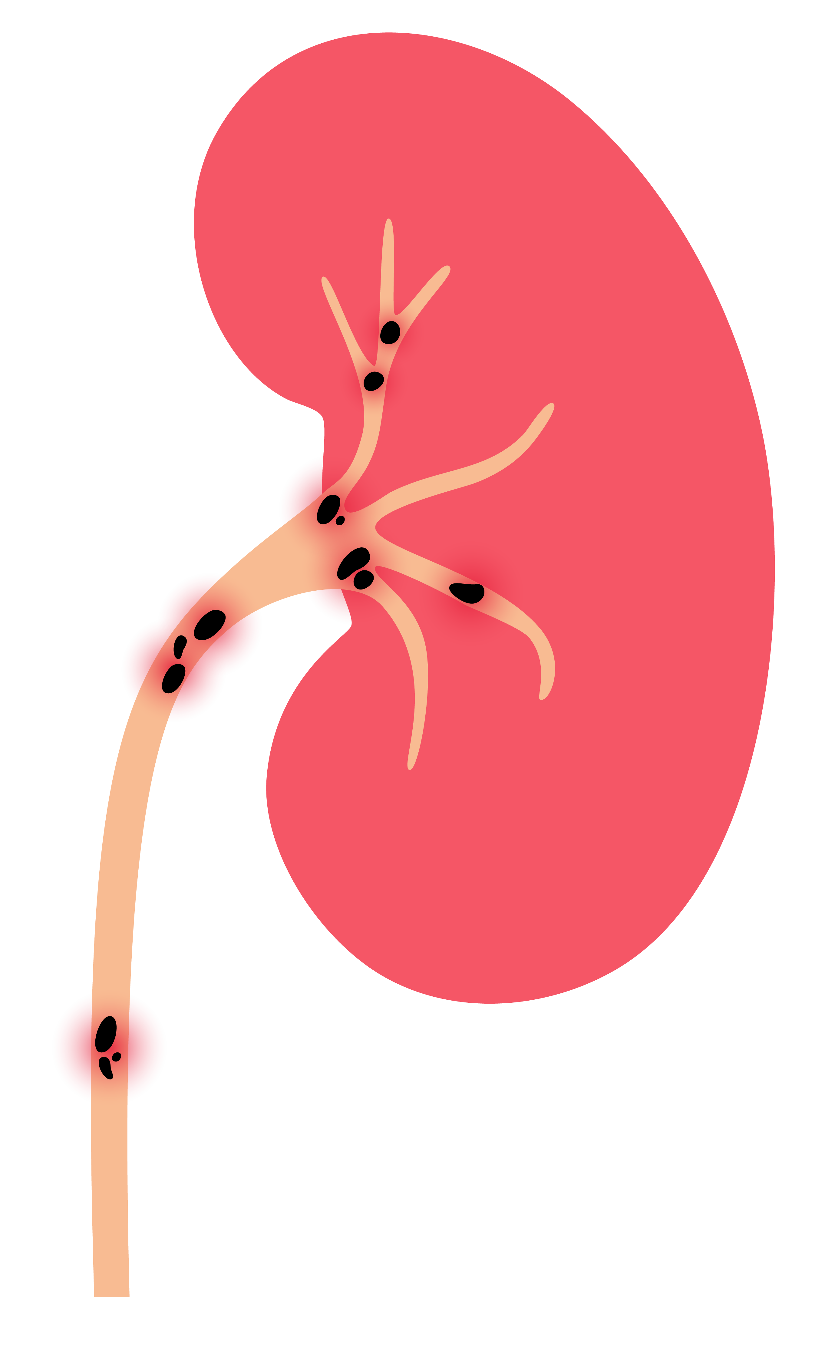 Illustration of kidney stones blocking parts of the urinary tract and kidney anatomy.