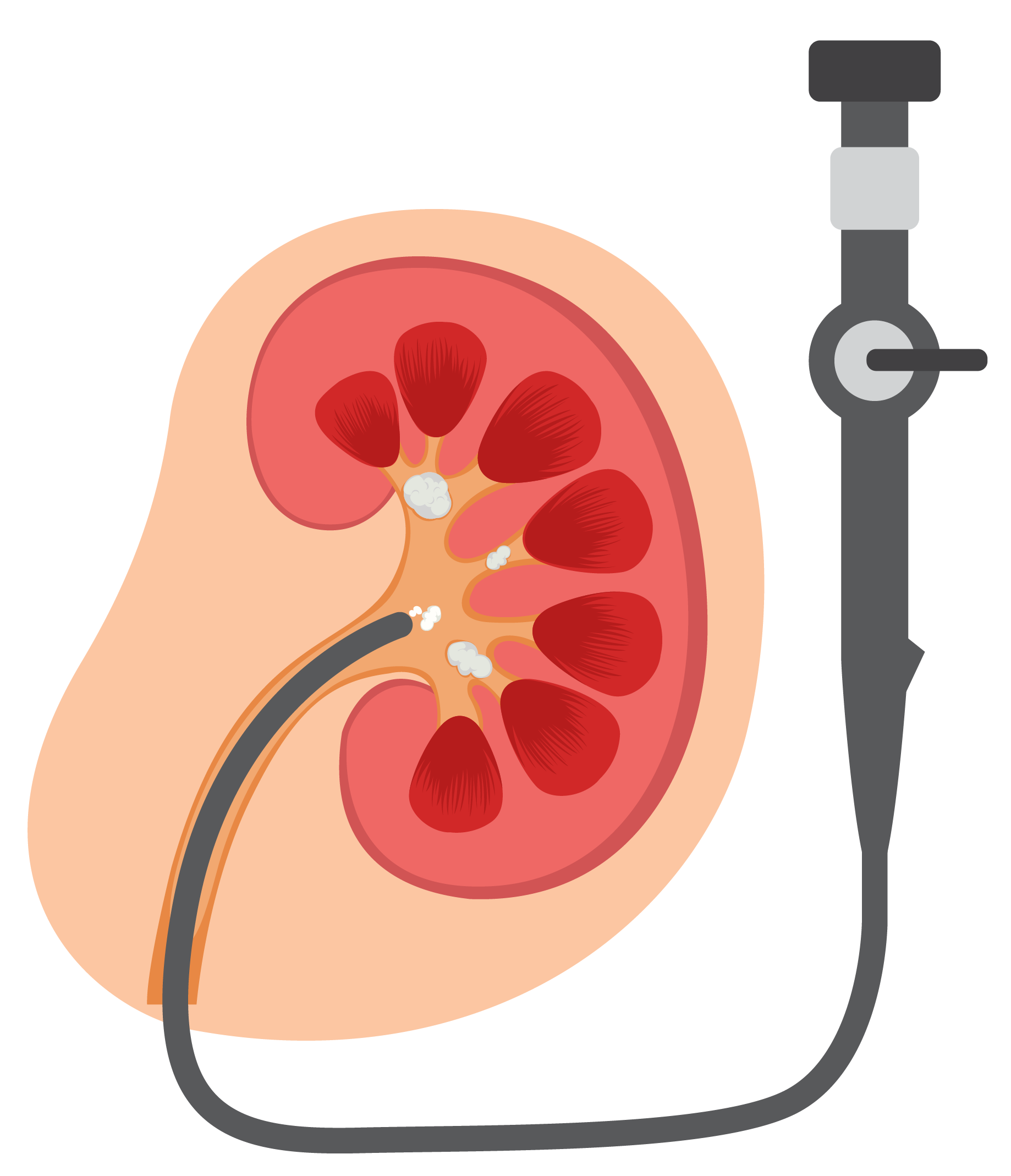 Illustration showing a kidney with percutaneous nephrolithotomy (PCNL) procedure for kidney stone removal