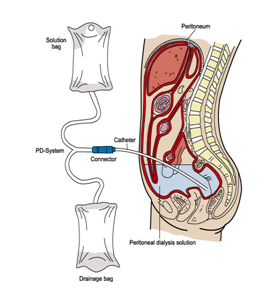 peritoneal dialysis diagram