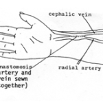 Arterio Venous Fistula | AVF Procedure | NU Hospitals Bangalore,India