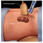 Kidney Biopsy