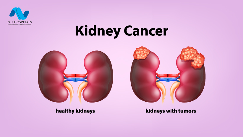 Kidney Cancer: Symptoms, Causes & Diagnosis Treatment