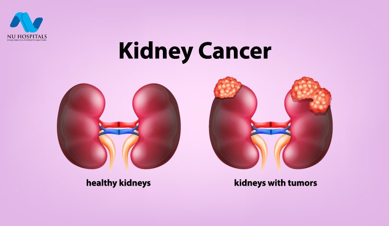 What Is Kidney Cancer?
